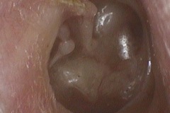 Atelectasis, dry secretion crust running out from lateral process of malleus, ISJ eroded, R ear