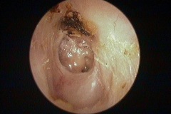 Atelectasis, retracted malleus handle on promontory, no LPI, pllasterd thin TM on stapes head and stapedius tendon, crust obscures attic, L ear. Expanded or eroded ear canal floor.