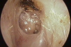 Atelectasis, retracted malleus handle on promontory, no LPI, pllasterd thin TM on stapes head and stapedius tendon, crust obscures attic, L ear