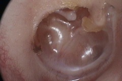 Atelectasis, with middle ear effusion, R ear, eroded LPI