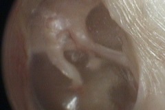 Auto atticotomy, eroded outer attic wall by cholestetoma, now self healed, malleus head, incus body and chorda tympani visible, L ear