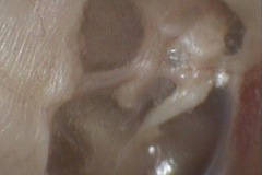 Auto cavity atticotomy, no history of surgery, slef healed cholesteatoma, exposed chorda, incus and malleus, L ear.
