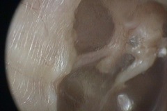 Auto-atticotomy erosion, thin tm lying on long process incus and chorda tympani nerve, L ear