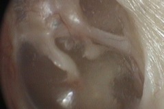 Auto-atticotomy, clean, stable, dry, thin TM adherent to malleus  and incus bones, eroded LP incus, stapes head, and chorda tympani nerve, L ear.