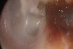 P-S pocket adherent to Incudo-Stapedial joint and Stapedius tendon, L ear