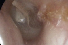 P-S pocket with pinhole perforation and trail of dried secretion running over annulus and small granuloma, and out along ear canal, L ear