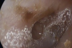 Perforated postero-superior retraction pocket, R ear, margin adherent to eroded Incudo-Stapedial joint