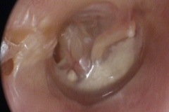Perforated wet retraction pocket, posterior TM, tympanosclerosis of anterior TM, R ear