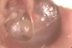 Postero-superior clean retraction pocket of R ear drum, the thin pocket is draped onto the stapes superstructure, stapedius tendon,promontory, and horizontal facial canal, long process of incus has eroded, serous fluid level seen through TM