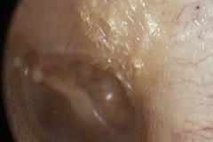 Postero-superior pocket, keratin trail out from pocket and over annulus, L ear