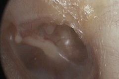 Postero-superior pocket, with 'trail' of dried secretion coming from pocket and migrating out along ear canal, L ear.