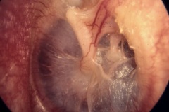 Postero-superior retraction pocket, attached to partially eroded LPI, slight keratin trail from pocket across annulus; small attic retraction, L ear.