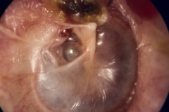 Postero-superior retrcation pocket onto ISJ; Crust in attic probably conceals dry cholesteatoma in an attic erosion, R ear.