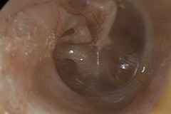 Retracted TM onto LPI, chorda, stapedius tendon, round window overhang, promontory, R ear.