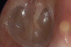 Retraction R ear drum