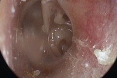 Retraction pocket, posterior, draped over intact incudo-stapedial joint, L ear