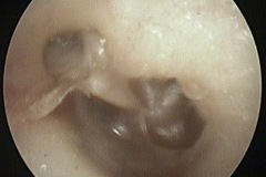 Retraction pockets, postero-superior and attic, glue ear, eroded LPI, TM draped over stapes, L ear, Pt J
