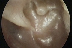 Retraction pockets, postero-superior and attic, glue ear, eroded LPI, TM draped over stapes, L ear, Pt J2