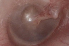 Shallow P-S pocket, R ear