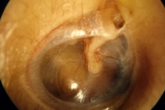 Thin TM, mild retraction of pars tensa and pars flaccida
