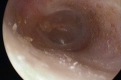 Thin drum anteriorly, intact and dry, thin section slightly retracted, L ear