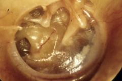 Atelectatic thin TM, draped over thin ISJ and stapedius tendon, onto promonptry and margin of RW overhang