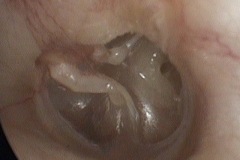 Postero-superior atelectasis, partly eroded LPI, exposed round window niche, L ear