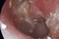Attic, active wet cholesteatoma, and middle ear effusion, L ear.