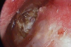 Cholesteatoma arising from pocket in anterior part of TM, left ear.