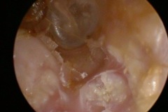 Cholesteatoma of ear canal floor