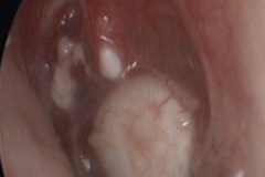 Cholesteatoma pearl in TM, residual, previous tympanoplasty, L ear.