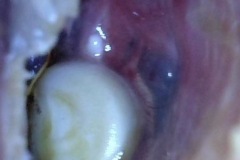 Cholesteatoma, 'pearl' in left ear, posterior drum, previous tympanoplasty.