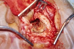 Cholesteatoma, large, filling L mastoid, bony cavity has been eroded by cholesteatoma, seen via postaural incision.