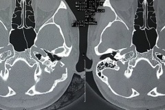 Large cholesteatoma eroding canal wall, mastoid cortex, posterior fossa dural plate.