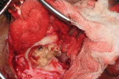 Large cholesteatoma eroding mastoid bone and posterior canal wall, R ear.