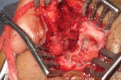 Large cholesteatoma eroding through mastoid cortex, after removing debris, showing erosion by diisease.