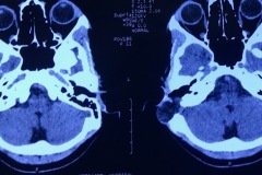 Residual cholesteatoma, 8 y after MRM, large sac eroding cortex and sinus plate, no intracranial extension,15 y girl,axial CT scan.