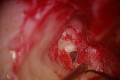 Surgical sequence 2, cholesteatoma in attic, after inus removal, R ear atticotomy.