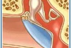 Attic, early cholesteatoma