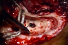 CI insertion in round window, R ear.j