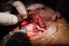 Cochlear Implant, R ear 30y male.