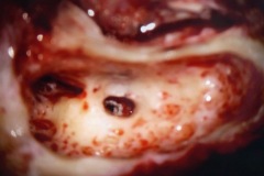 Posterior tympanotomy, R ear, ready for CI electrode placement via round window.