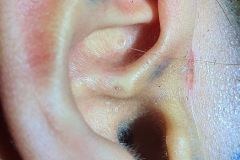 Auricular sinuses, root of helix, and in cymba, had recent i & D preauricular abscess, subsequently had surgery to excise the sinuses, the underlying perichondrium and all soft tissue down to temporalis fascia.