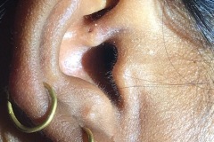 Congenital sinus of root of helix, recurent infections, L ear.