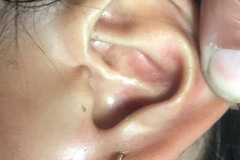 First Branchial cleft sinus in front of left ear lobe, recurrent dischage.