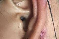 First Branchial cleft sinus in front of lobe, with infected nodes/skin behind lobe, (explored with parotid approach and dissection to preserve VII), no connection to EAC.