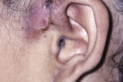 Pre-auricular sinus, active infection.