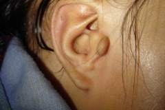 Accessory auricle, skin tag.