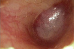 Atresia ear canal, acquirred following infection, right ear.