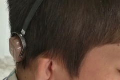 Atresia, microta, bilateral, young boy, with bone conducting hearing aid on spring 'Alice' head band.
